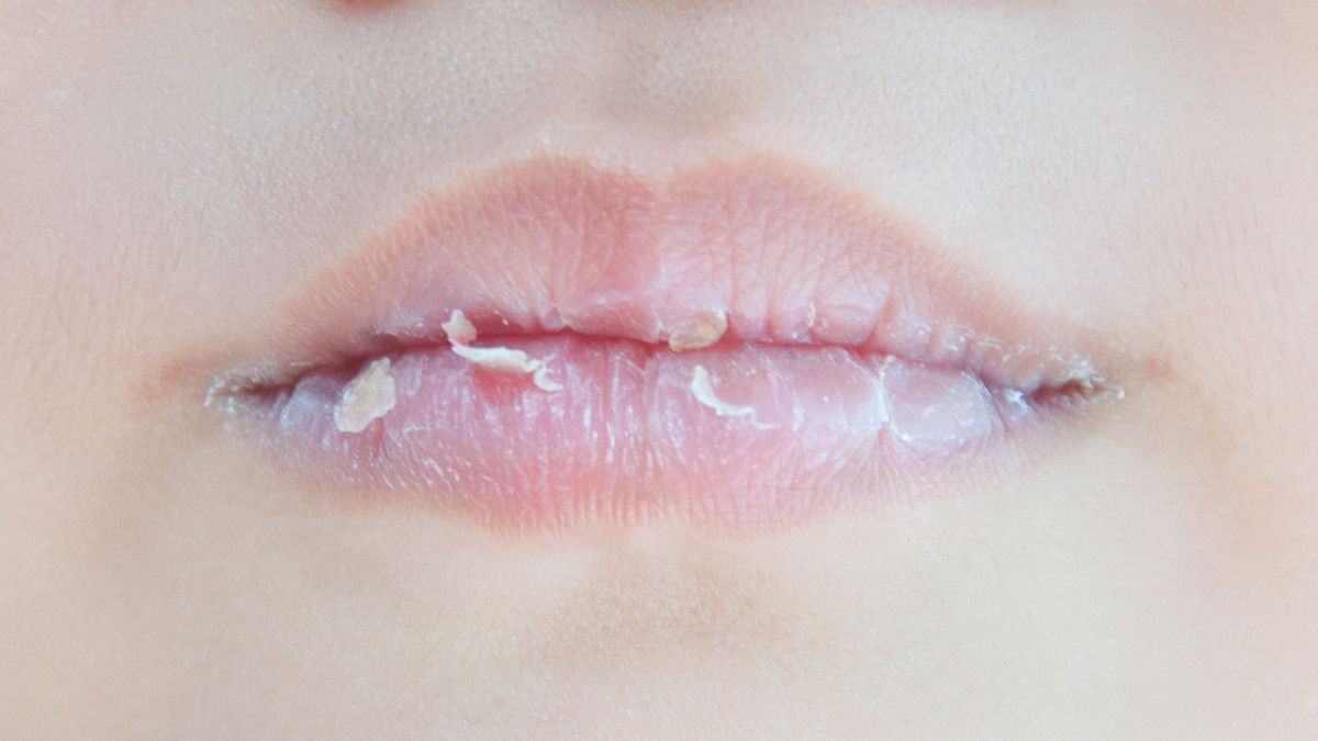Cara Mengatasi Bibir Kering Pecah dengan Alami