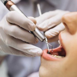 Segala Hal Seputar Pembersihan Karang Gigi Untuk Manfaat Jangka Panjang