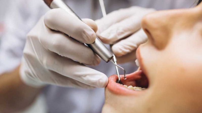 Segala Hal Seputar Pembersihan Karang Gigi Untuk Manfaat Jangka Panjang